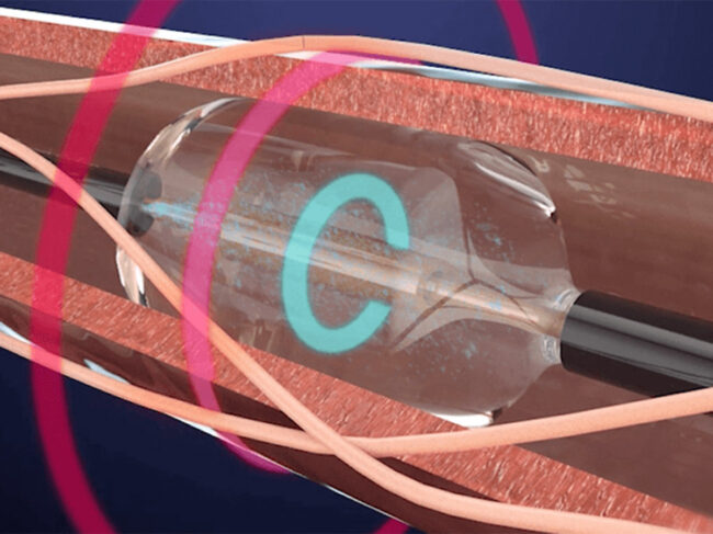 Recor Medicaal Paradise renal denervation catheter