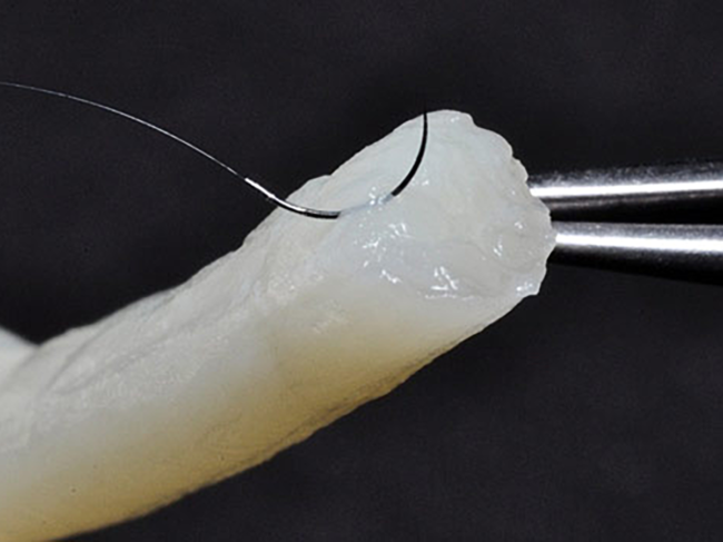 Axogen Avance Nerve Graft