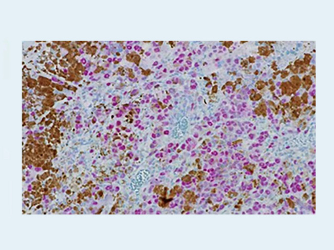 Anti-PRAME - rabbit monoclonal primary antibody - Roche Diagnostics