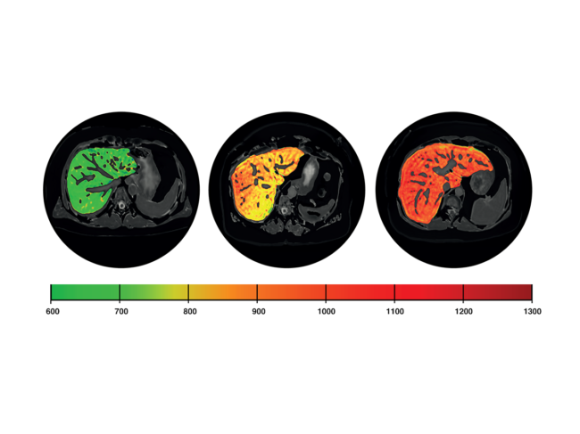 Colorized liver scans ranging in green, yellow and red