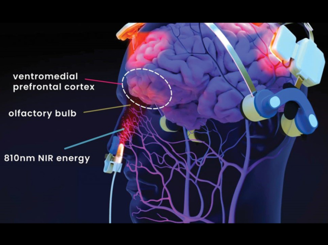 Vielight treatment for long COVID-19