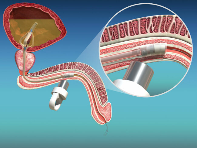 Ingenion Medical Cymactive 2