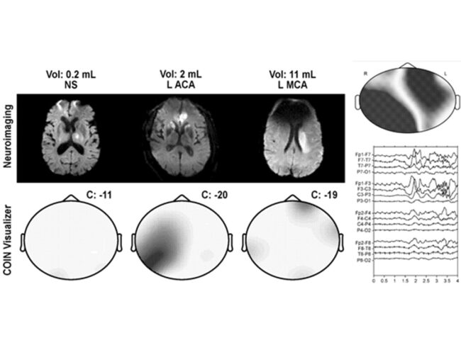 Patent: “Methods and systems for detecting stroke.”