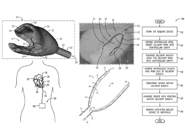 intracardiac pulsatile ventricular assist device