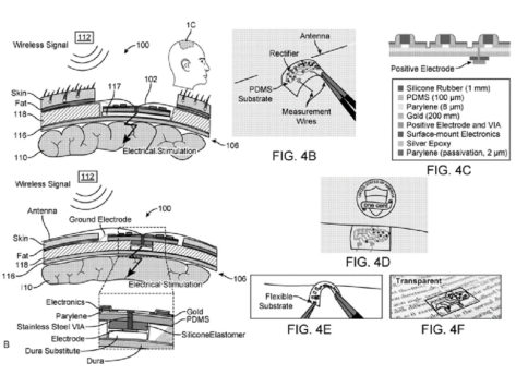 Wireless brain implant 11july24