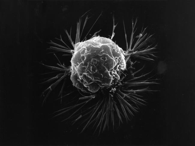 Breast cancer cell