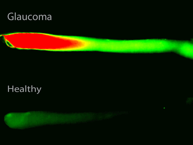 Leakage in the barrier between the eye and the optic nerve in<br /> glaucoma