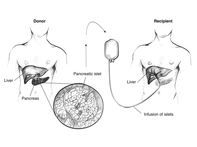 Islet transplantation schematic