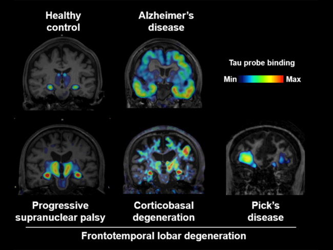 Frontotemporal lobe degeneration