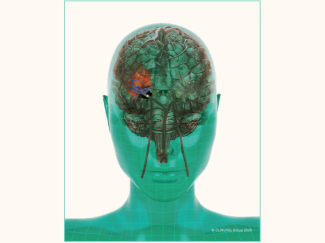 Clinuvel stroke illustration