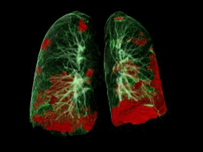 CT lung scan