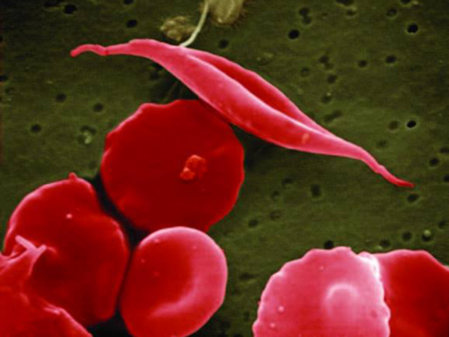 Sickle cell disease