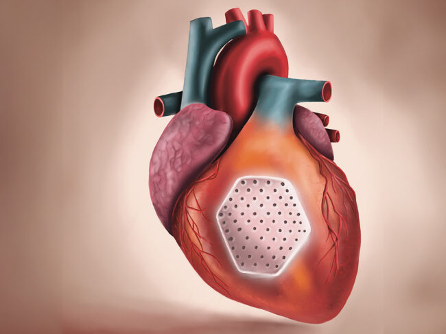 Heart patch produced from induced pluripotent stem cells derived heart muscle cells in a collagen hydrogel