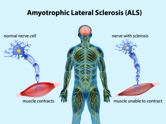 amyotrophic lateral sclerosis - Students