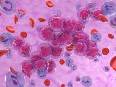 Cancer acute lymphoblastic leukemia