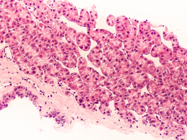 Photomicrograph of hepatocellular carcinoma