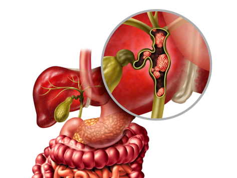 Illustration of cancer in the bile ducts