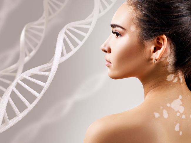 Woman with vitiligo