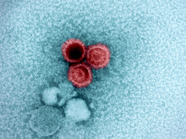 Epstein-Barr virus