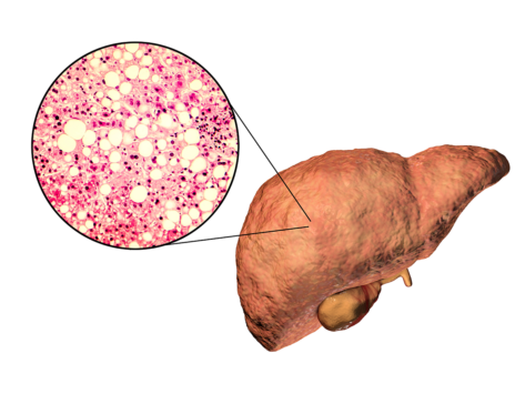 Fatty liver steatosis triglyceride