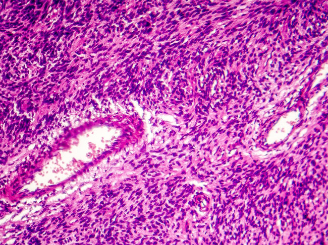 Light micrograph of fibrosarcoma, a type of soft tissue sarcoma