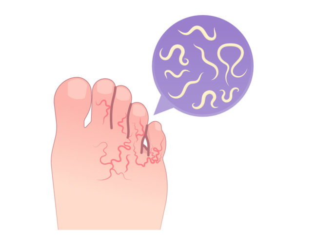 Illustration of hookworms in foot