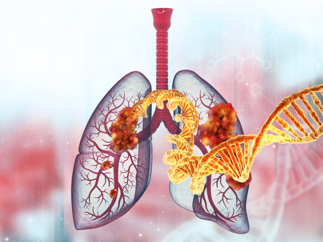 Illustration of lung cancer, DNA double helix