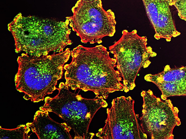 Metastatic melanoma cells.