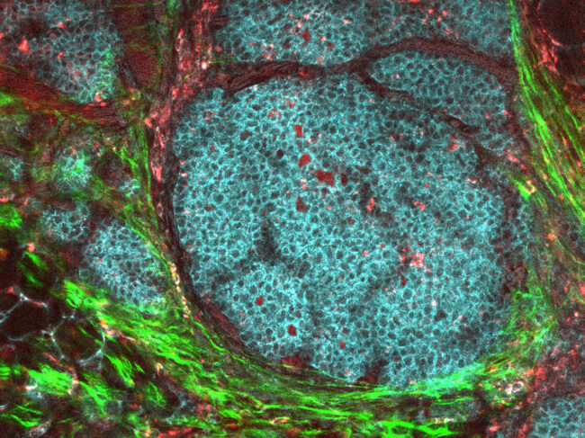 Breast cancer tumor and its microenvironment obtained from a live mouse model.