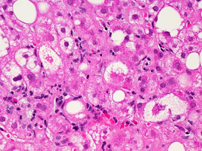 A microscopic image of liver tissue affected by metabolic dysfunction-associated steatotic liver disease.