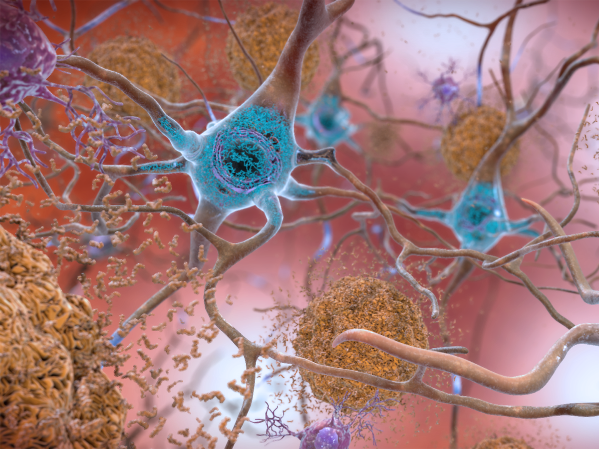 Blood-based Test For Alzheimer’s Disease Surpasses 96% Accuracy | BioWorld