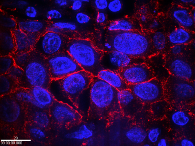 Colorized micrograph of breast cancer cells with the HER2 protein (red).