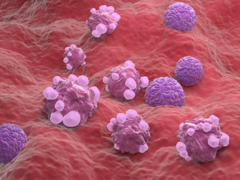 Ovarian cancer cells