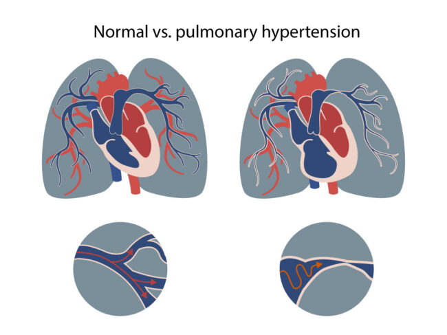 Illustration of heart and lung vasculature in pulmonary hypertension vs. normal