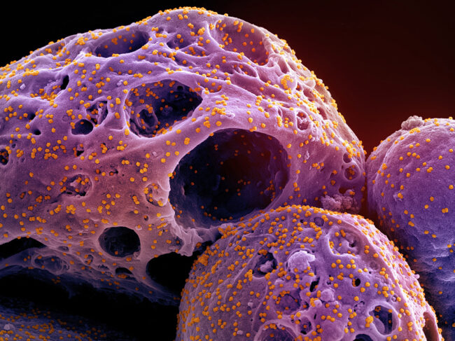 Scanning electron micrograph of a cell infected with the Omicron strain of SARS-CoV-2 virus particles 