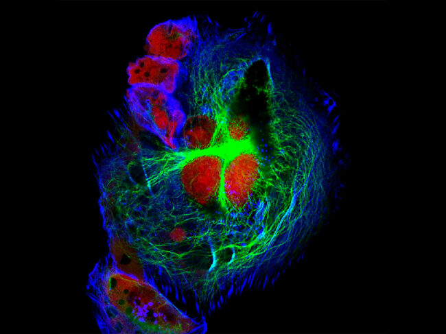 Real fluorescence microscopic view of human neuroblastoma cells