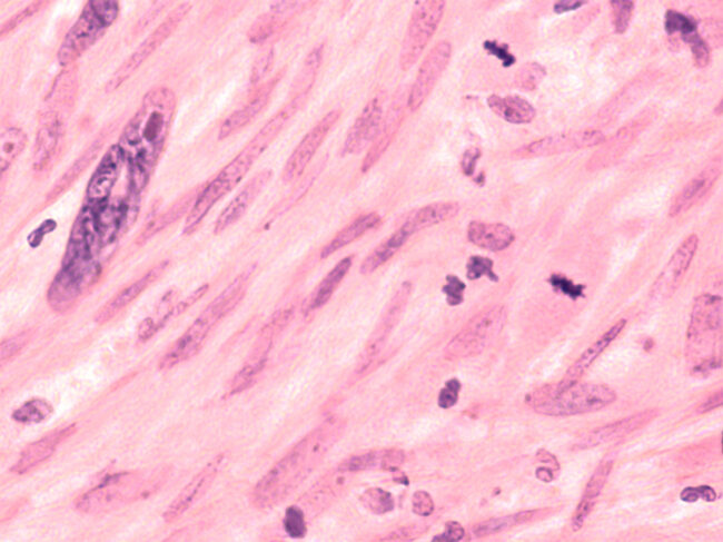 Microscopic image of a leiomyosarcoma