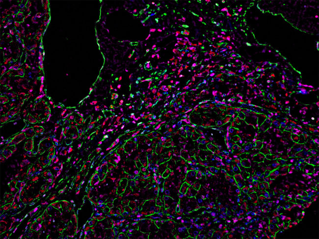 Immunofluorescence image shows macrophages in human clear cell renal cell carcinoma
