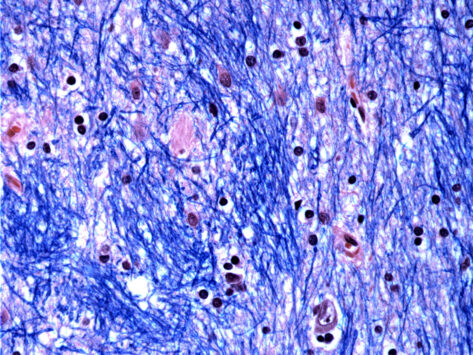 Histological staining of the caudate nucleus from a person with Huntington’s disease.