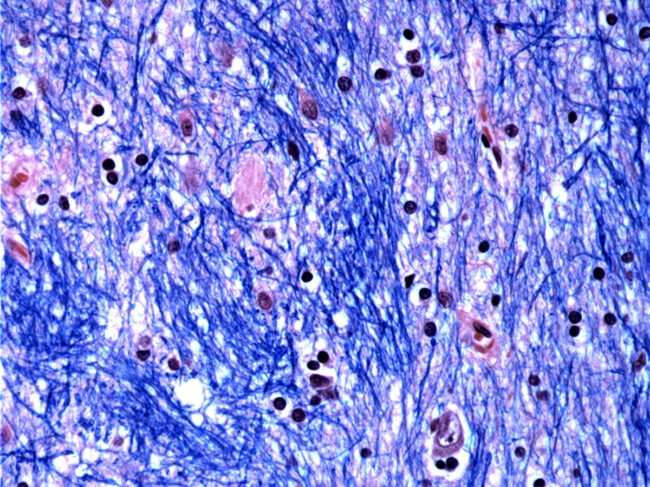 Histological staining of the caudate nucleus from a person with Huntington’s disease.