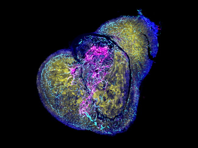 Human ossicle engrafted with human neuroblastoma cells.