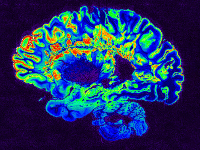 MRI scan of a fixed cerebral hemisphere from a person with multiple sclerosis