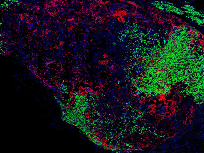 Stem cell-derived vertebral bone with recruited breast cancer tumor cells