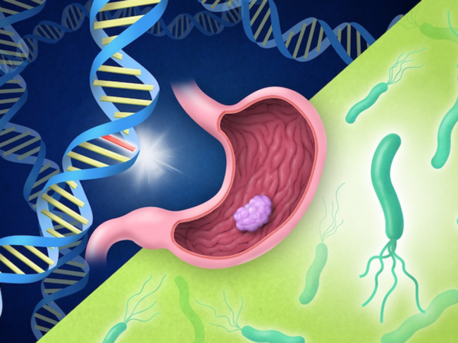 Concept art for H. pylori infection and gastric cancer risk