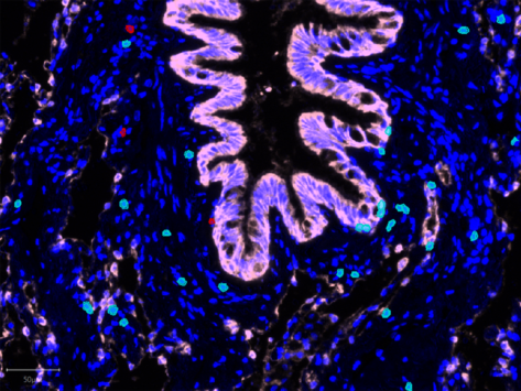 Wehi trm smoker lung tissue