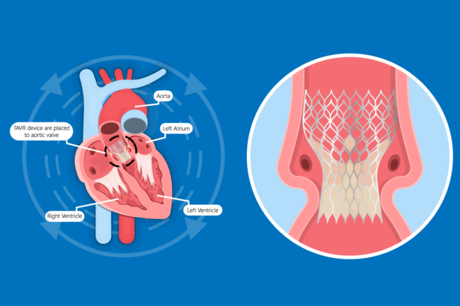 Illustration of TAVR device