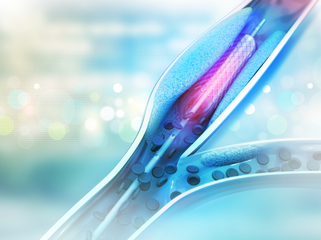 Illustration of stent angioplasty balloon in artery