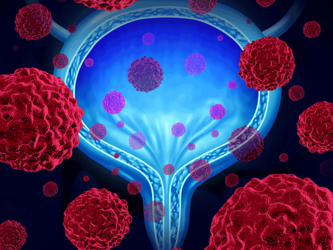 Bladder cancer illustration