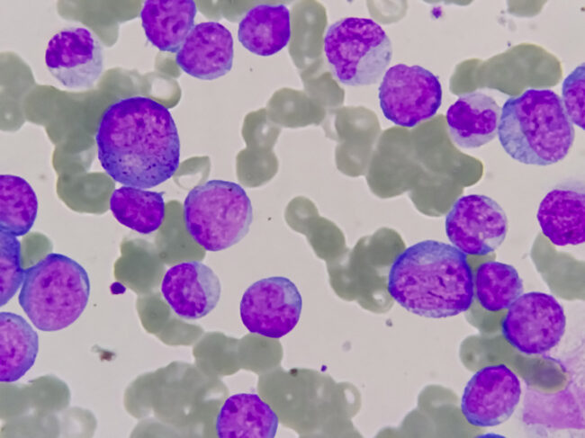 Photomicrograph of bone marrow aspirate showing myeloblasts of acute myeloid leukemia