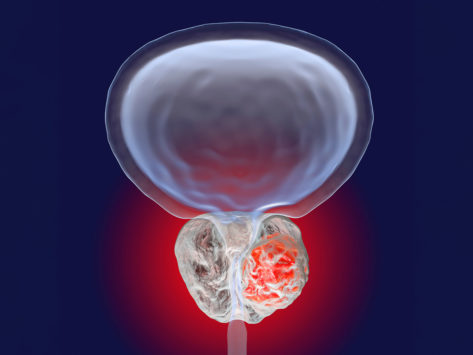 Cancer prostate illustration